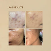 Asaya Advanced Spot Pigmentation Face Serum | Reduces Dark Spots, Melasma, Acne Marks & Hyperpigmentation | MelaMe™ Complex, Niacinamide & Alpha Arbutin | Evens Skin Tone & Brightens Dull Skin | For Men & Women  - 30ml