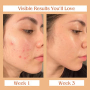 Auravedic Kumkumadi Oil For Face 100 Ml, Kumkumadi Tailam Face Oil For Glowing Skin, Dark Spot Corrector Face Serum