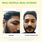 Avimee Herbal 10% Vitamin C Serum for Glowing Skin | Enriched with Hyaluronic Acid | Non Irritating, Safe for Sensitive Skin | Non Sticky | Clinically Proven Formula | For Men and Women| 25 mL