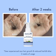 WishCare Hair Growth Serum Concentrate | Redensyl, Anagain & Rosemary | Boosts New Growth & Controls Hairfall | Hair Growth Serum for Scalp | In-Vivo Tested | For Men & Women | 30ml