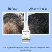WishCare Hair Growth Serum Concentrate | Redensyl, Anagain & Rosemary | Boosts New Growth & Controls Hairfall | Hair Growth Serum for Scalp | In-Vivo Tested | For Men & Women | 30ml