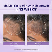 Bare Anatomy Nature x Science Rosemary Hibiscus Hair Growth Oil for Women & Men | Promotes New Hair Growth & Strengthens Hair | Nourishes Scalp & Controls Hair Fall | Suitable for All Hair Types-100ml